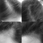 smp-for-women-10-scalp-micro-pigmentation